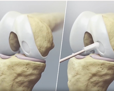 Best MACI Cartilage Surgeon in Los Angeles: Advanced Cartilage Restoration for Knee Injuri...